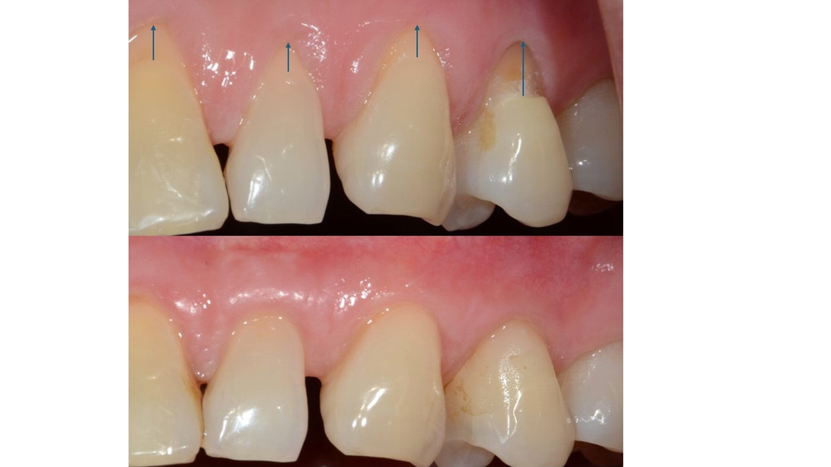 성공률 95%, 당뇨 임플란트의 오해와 진실 : 원데이치과 블로그, image size:1200x675