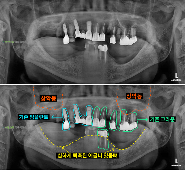 처음 내원 시 파노라마, 80대 남성 (2025.10 촬영) 