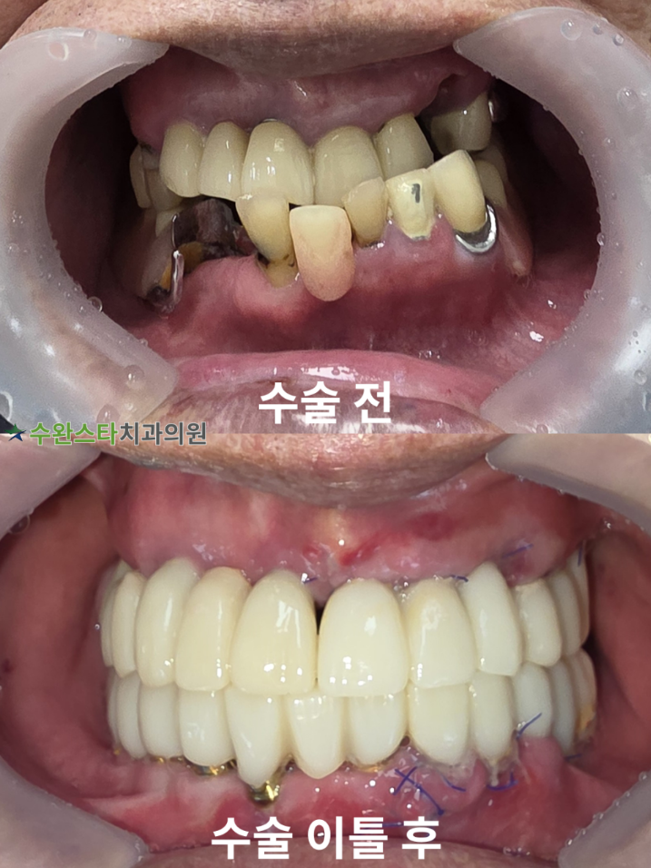 수술 전 / 수술 후 2일 구강 내부 80대 남성 (2025.10촬영)  ​