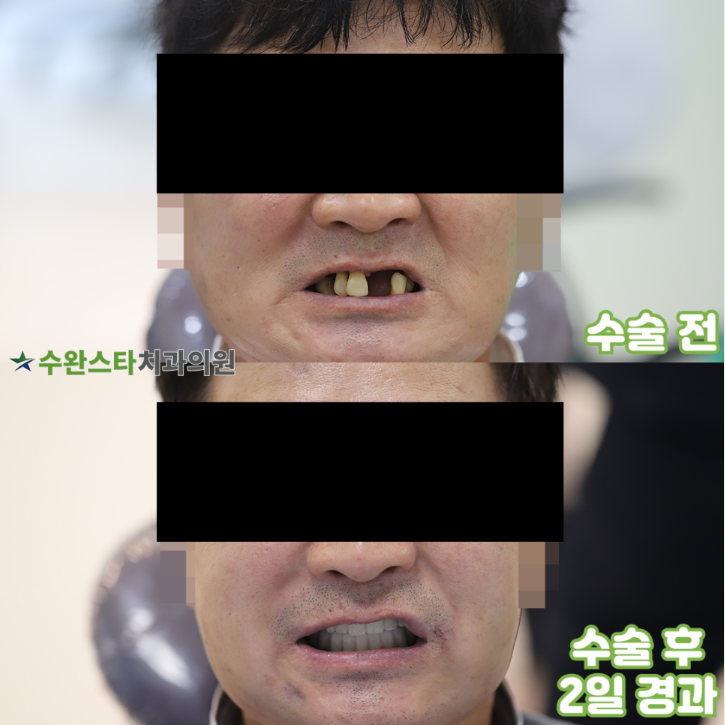 수술 전 / 수술 후 2일 경과, 50대 남성 (2025.7 촬영)