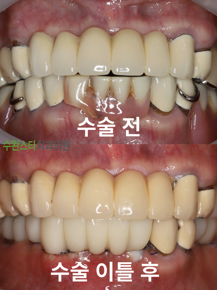 수술 전 / 수술 후 2일 구강 내부 80대 여성 (2025.8촬영)  ​