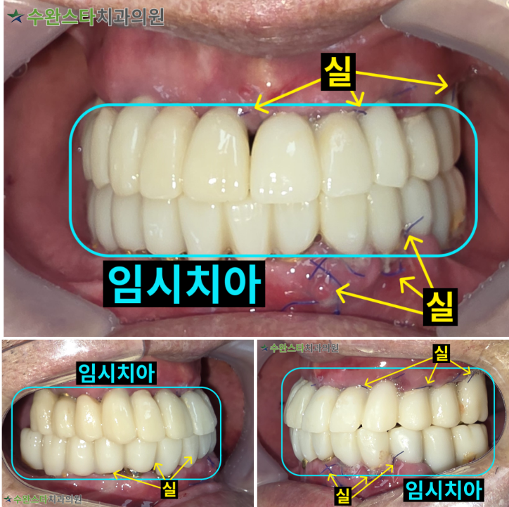 수술 2일 후 임시치아, 80대 남성 (2025.10 촬영)  ​