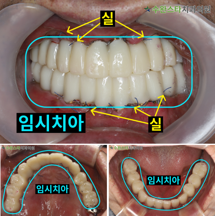 수술 2일 후 임시치아, 50대 남성 (2025.7 촬영)