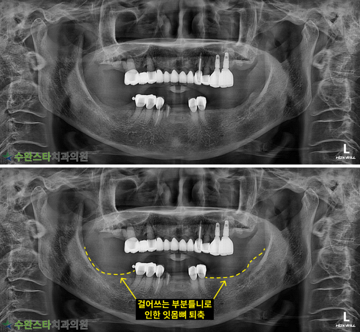 처음 내원 시 파노라마, 80대 여성 (2025.8 촬영)