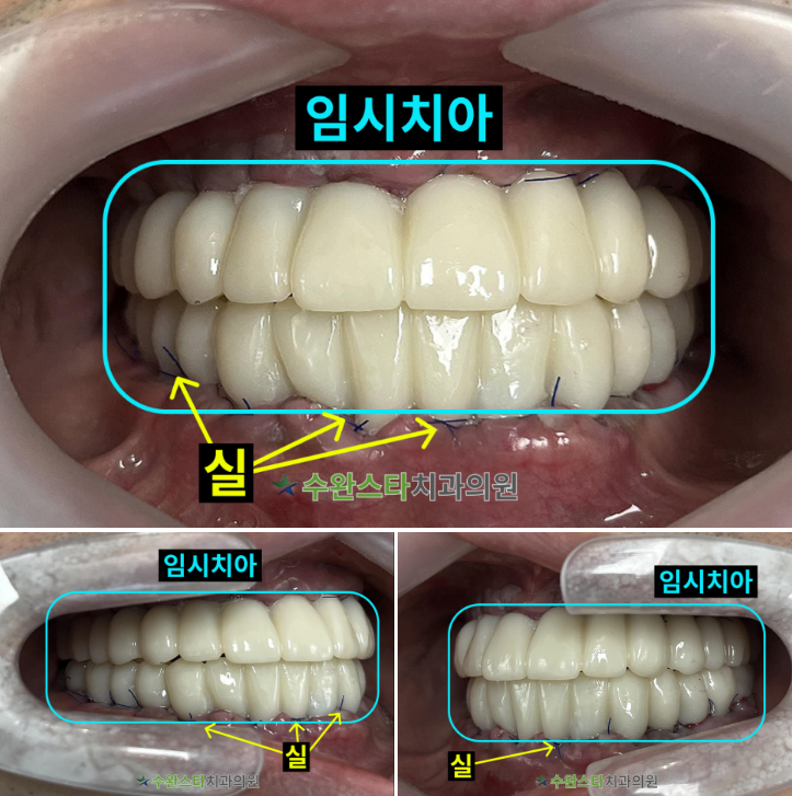 수술 2일 후 임시치아, 40대 남성 (2025.10 촬영)