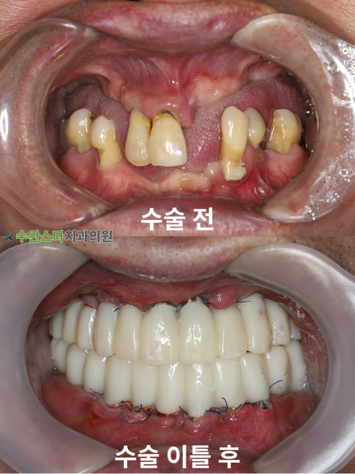 수술 전 / 수술 후 2일 구강 내부 50대 남성 (2025.7 촬영)
