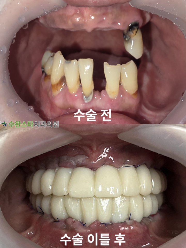 수술 전 / 수술 후 2일 구강 내부 40대 남성 (2025.10 촬영)