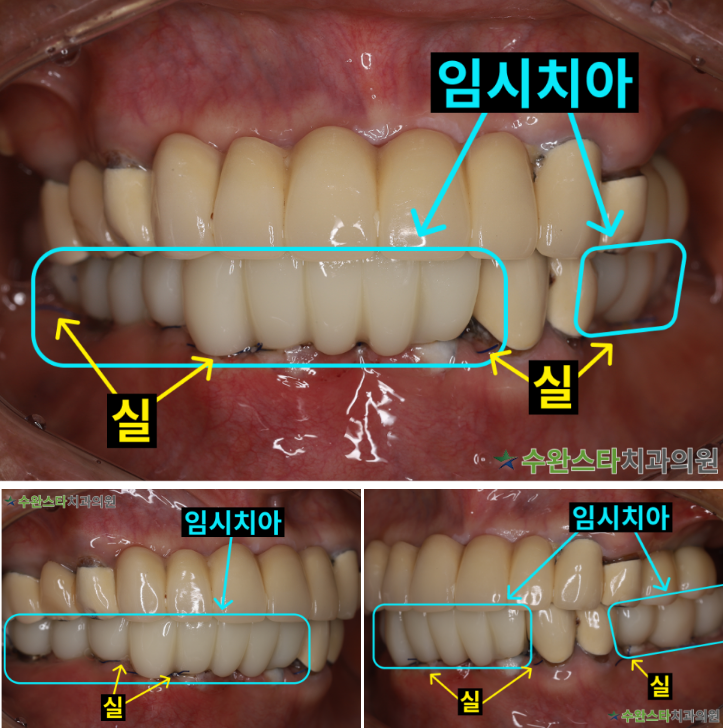 수술 2일 후 임시치아, 80대 여성 (2025.8 촬영)   ​