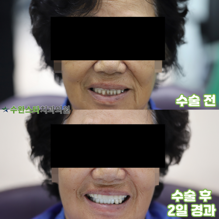 수술 전 / 수술 후 2일 경과, 80대 여성 (2025.8 촬영)