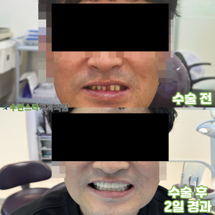 수술 전 / 수술 후 2일 경과, 40대 남성 (2025.10 촬영)