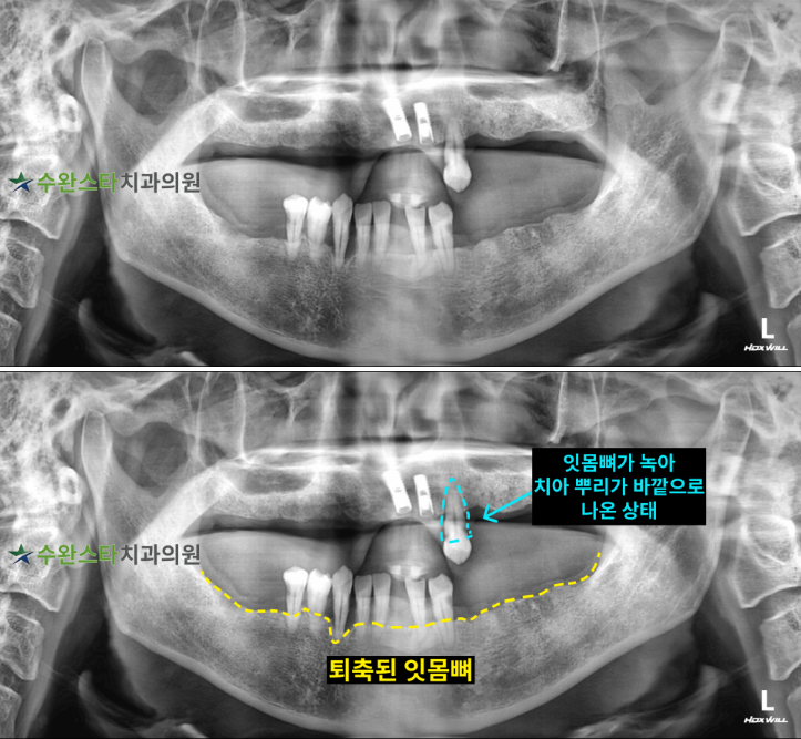처음 내원 시 파노라마, 40대 남성 (2025.10 촬영) 