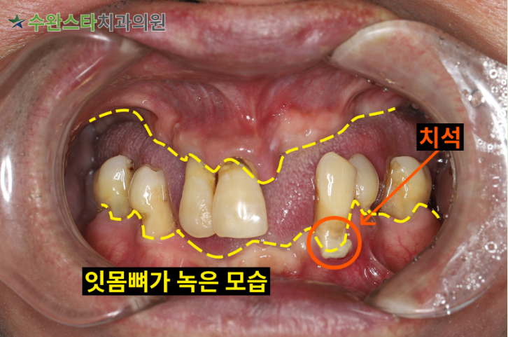 처음 내원 시 구강 내부 사진, 50대 남성 (2025.7 촬영)