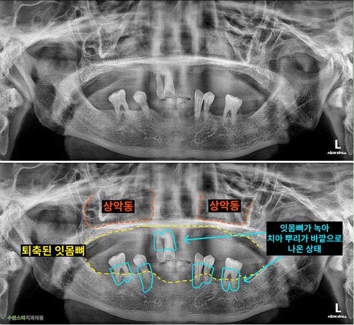 처음 내원 시 파노라마, 50대 남성 (2025.7 촬영) 
