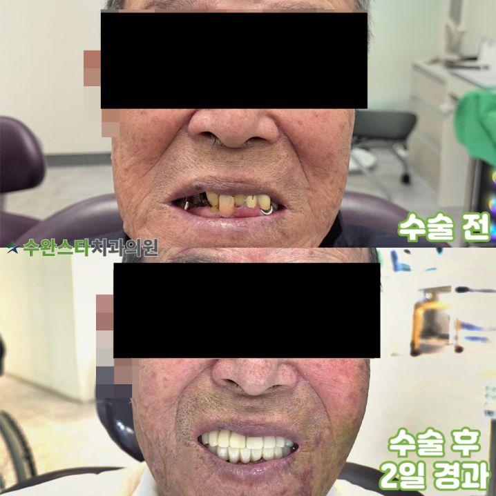 수술 전 / 수술 후 2일 경과, 80대 남성 (2025.10 촬영)