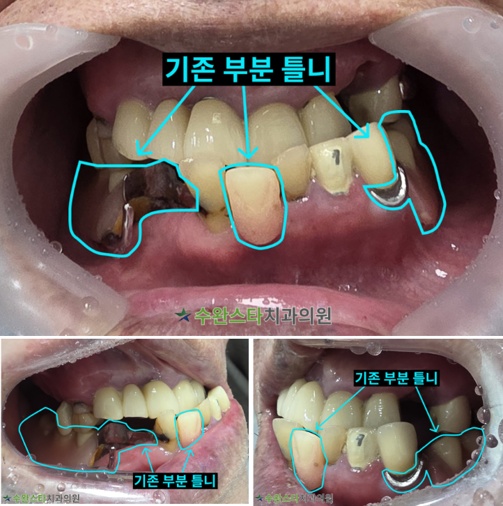처음 내원 시 구강 내부 사진, 80대 남성 (2025.10 촬영)  ​