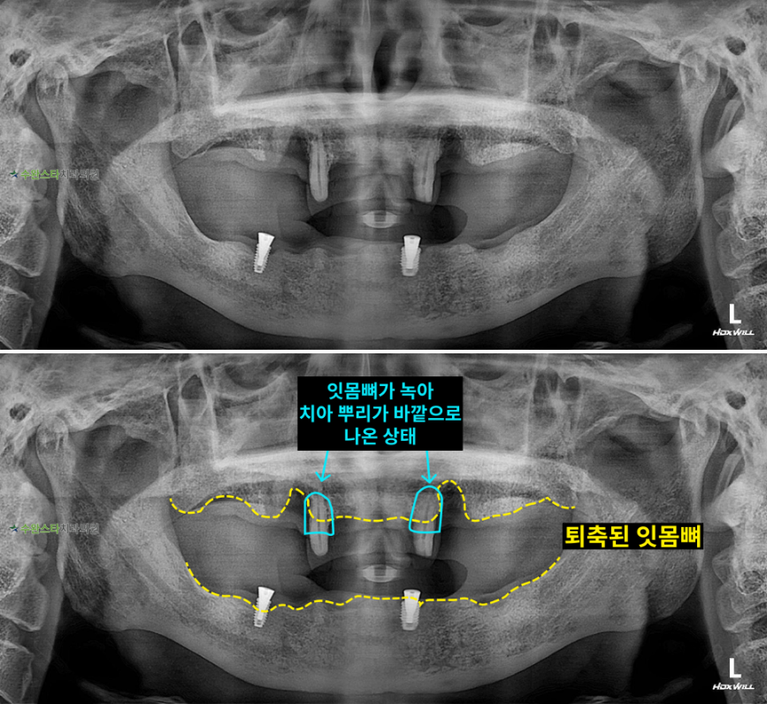 내원 시 파노라마, 60대 남성 (2025.11 촬영)