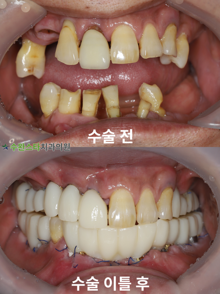 수술 전 / 수술 후 2일 구강 내부 50대 남성 (2025.7 촬영)
