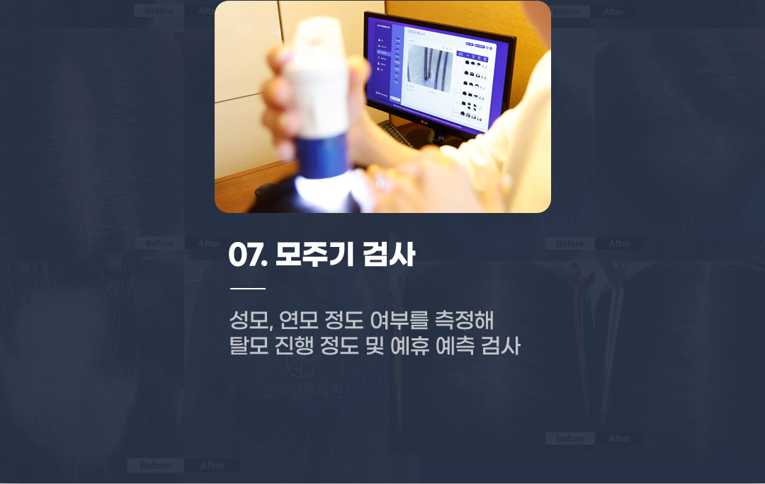 07 모주기 검사 성모, 연모 정도 여부를 측정해 탈모 진행 정도 및 예휴 예측 검사