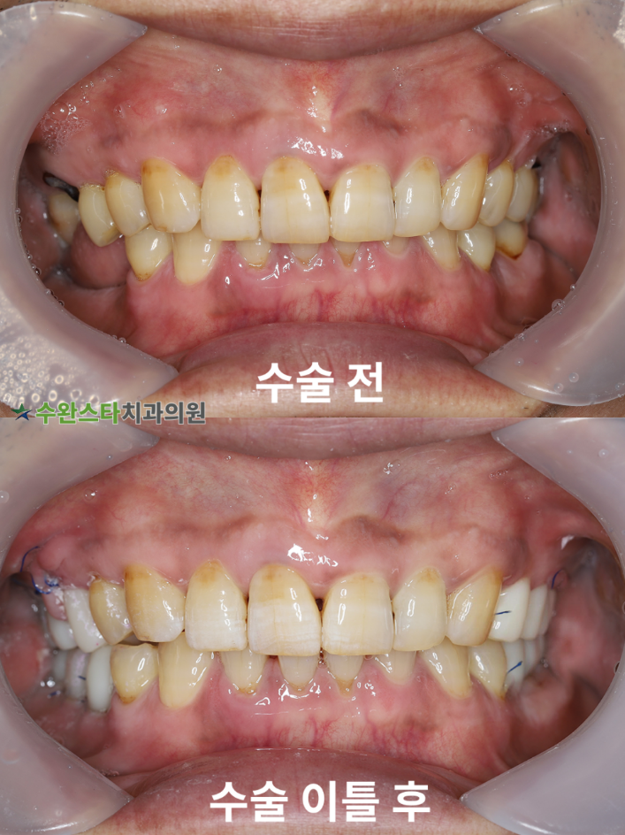 수술 전 / 수술 2일 후 구강 내부, 50대 남성 (2025.4촬영)