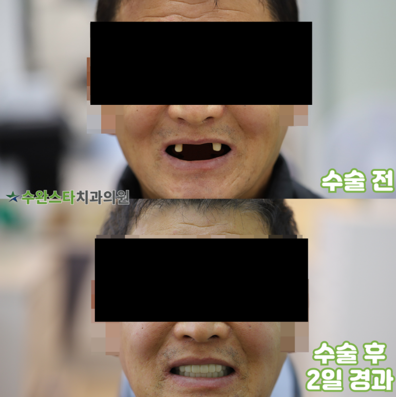 수술 전 / 수술 후 2일 경과, 60대 남성 (2025.11촬영)