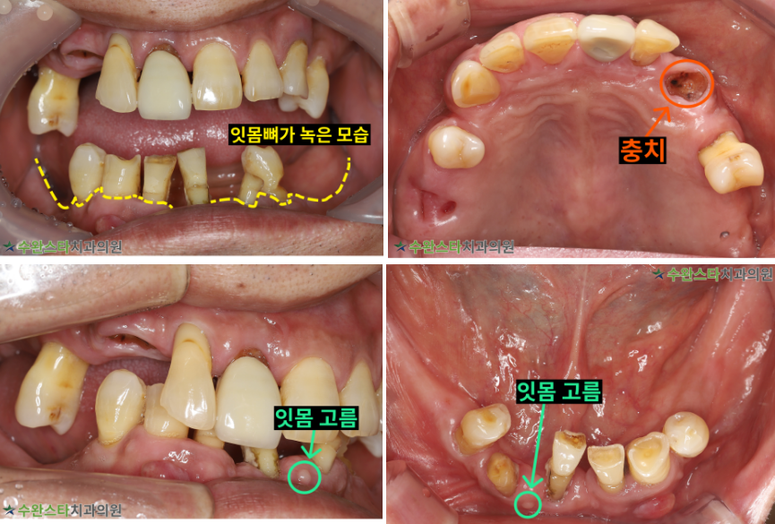 처음 내원 시 구강 내부 사진, 50대 남성 (2025.7 촬영)