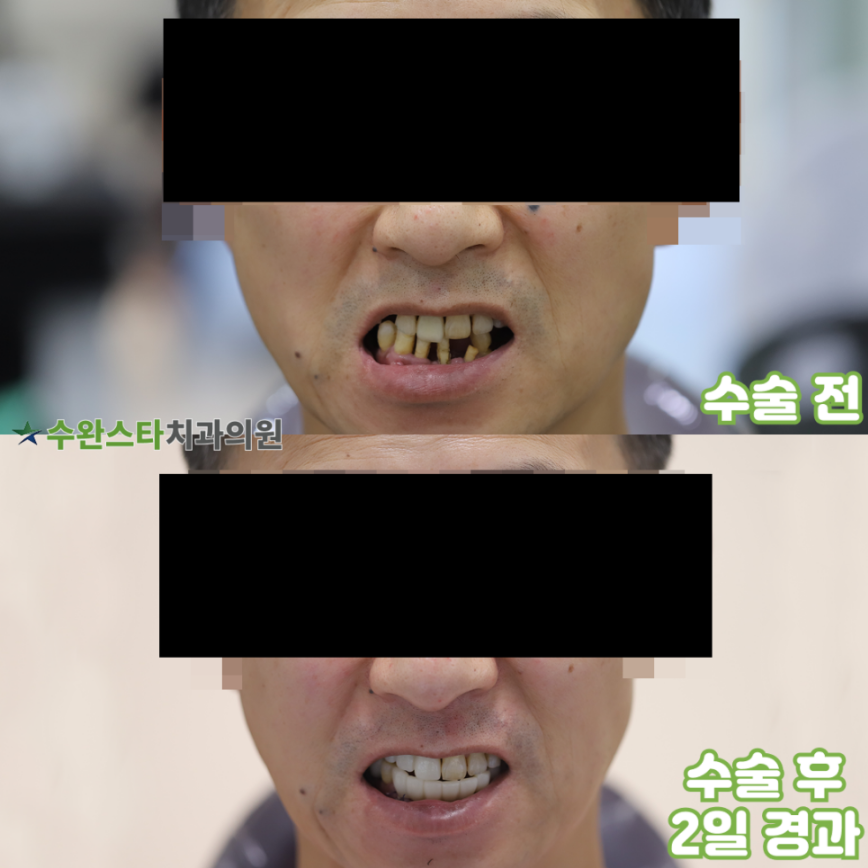 수술 전 / 수술 후 2일 경과, 50대 남성 (2025.7 촬영)