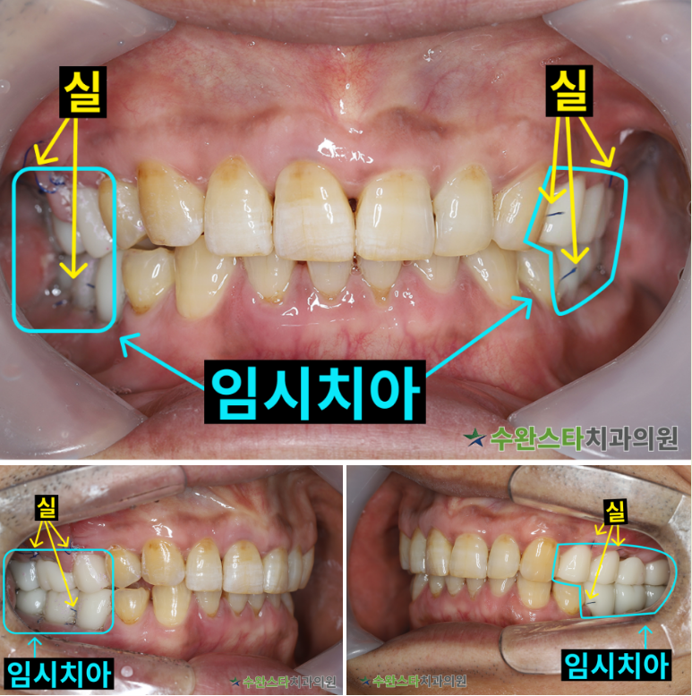 수술 전 / 수술 후 2일 구강 내부 50대 남성 (2025.4 촬영)