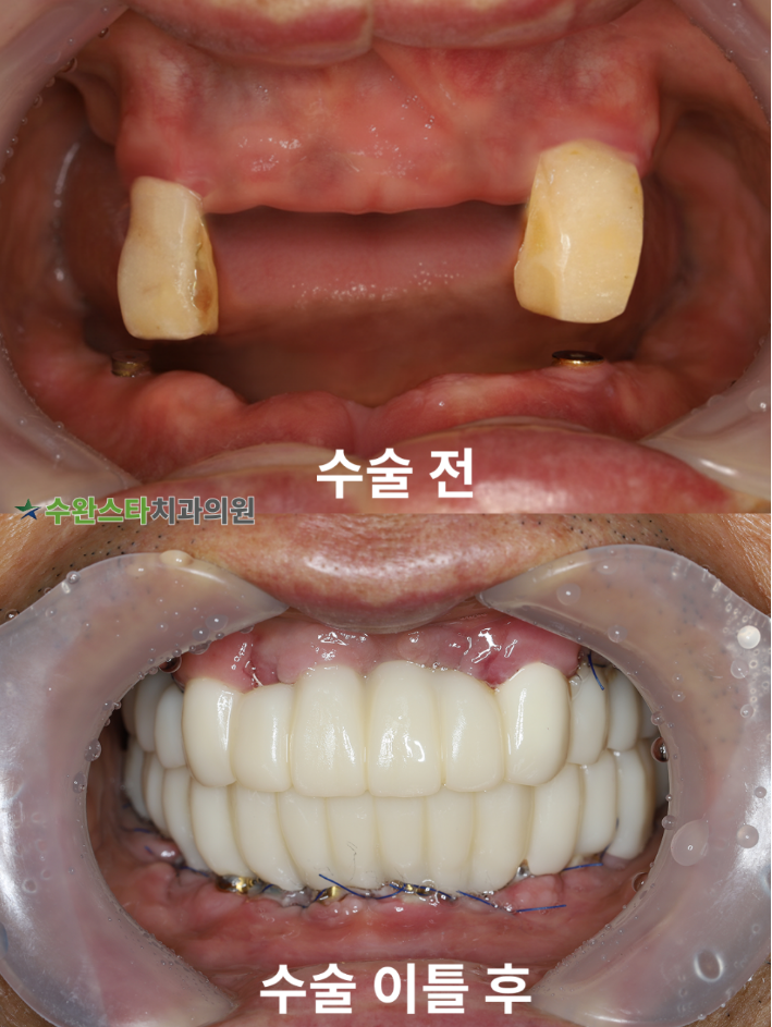 수술 전 / 수술 2일 후 구강 내부, 60대 남성 (2025.11 촬영)  ​