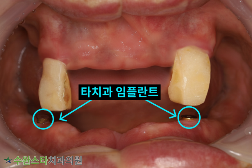 내원 시 구강 내부 사진, 60대 남성 (2025.11 촬영)  ​
