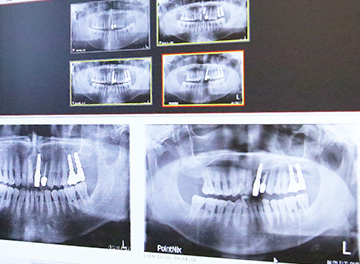 <p><br></p> <h5 style="text-align: center;"> <span style="background-color: #4999b7;     border-radius: 50px;     color: white;     padding: 0 8px;     font-size: 0.8em;">STEP 02</span></h5> <h4 style="text-align: center;"><span style="color: fff;">디지털 기술로<br>정밀 진단 합니다</span>   </h4><p><br></p>