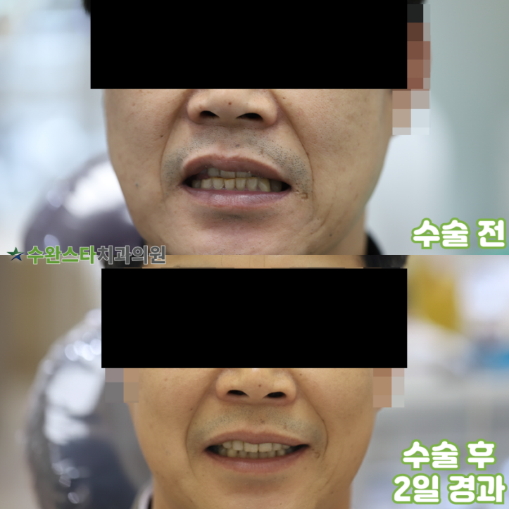 수술 전 / 수술 후 2일 경과, 50대 남성 (2025.4촬영)