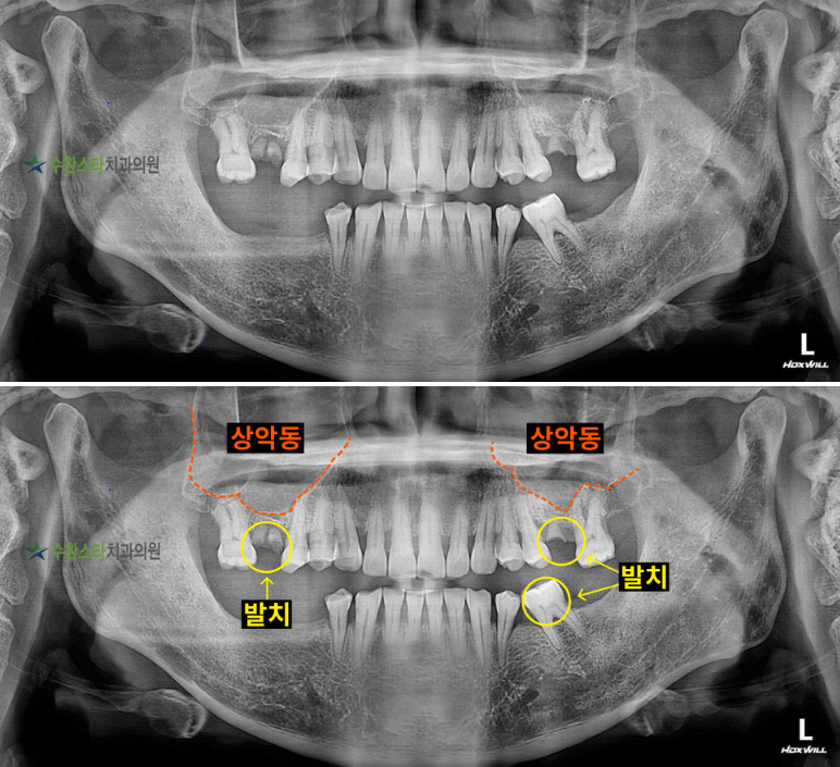 내원 시 파노라마, 50대 남성 (2025.4 촬영)