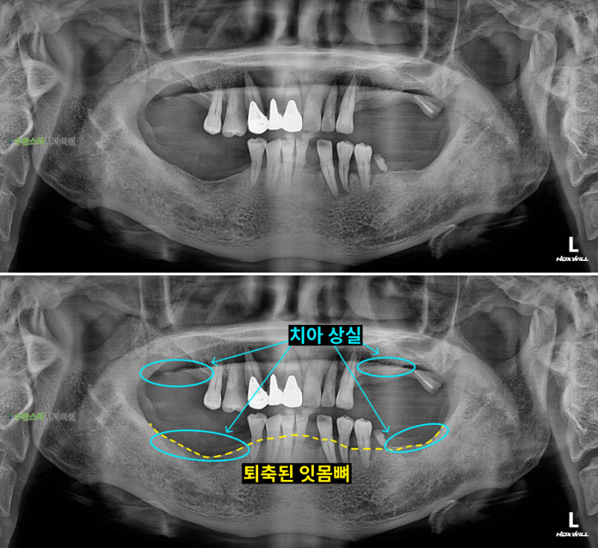 처음 내원 시 파노라마, 50대 남성 (2025.8 촬영) 