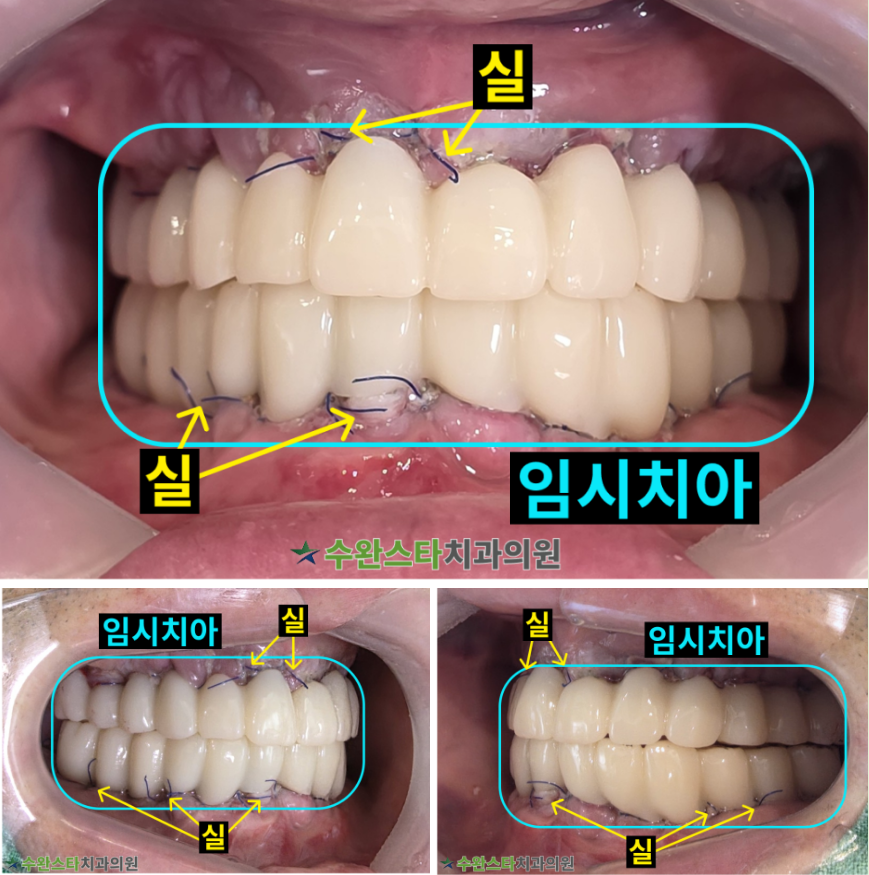 수술 2일 후 임시치아, 50대 남성 (2025.8 촬영) 
