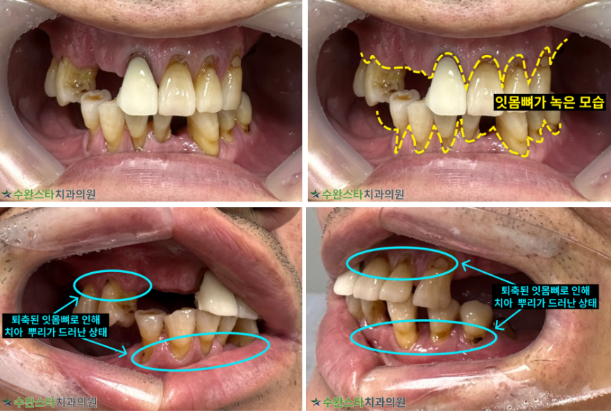 처음 내원 시 구강 내부 사진, 50대 남성 (2025.8 촬영)