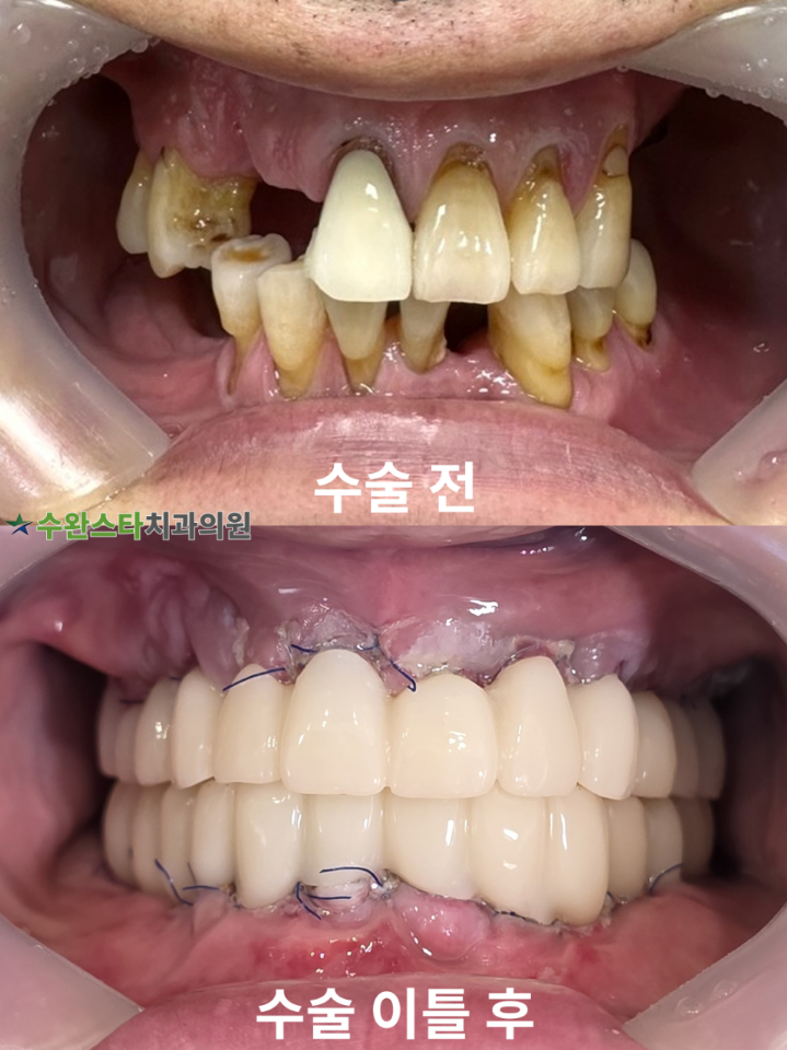 수술 전 / 수술 후 2일 구강 내부 50대 남성 (2025.8촬영)