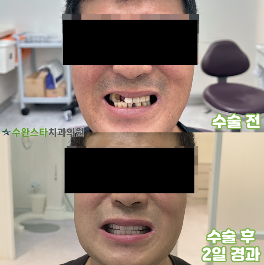수술 전 / 수술 후 2일 경과, 50대 남성 (2025.8 촬영)  ​