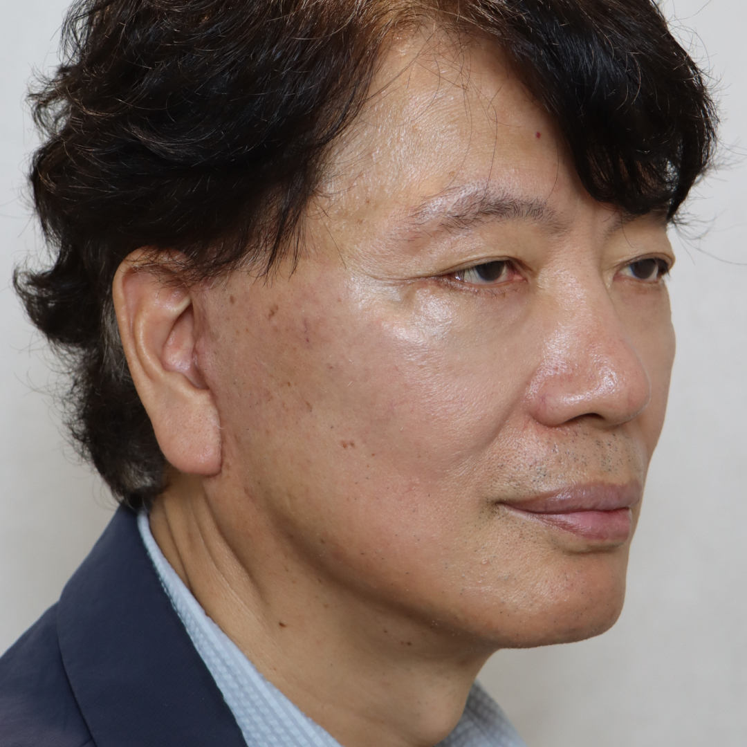 안면거상술 after측면 이미지