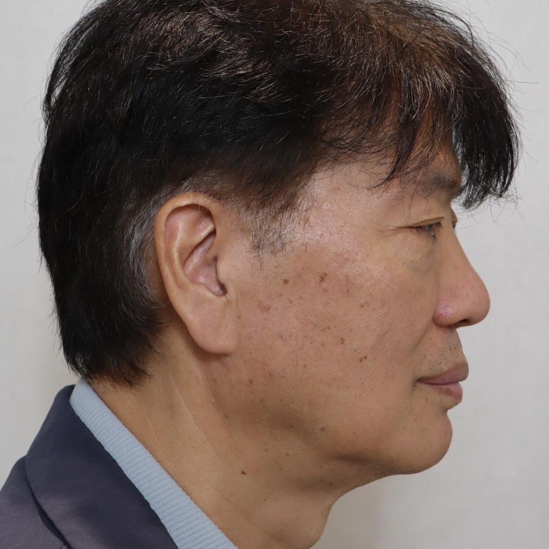 안면거상술 before 90도 이미지