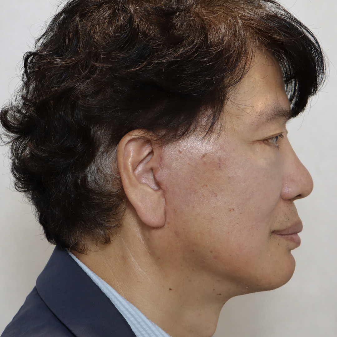 안면거상술 after 90도 이미지