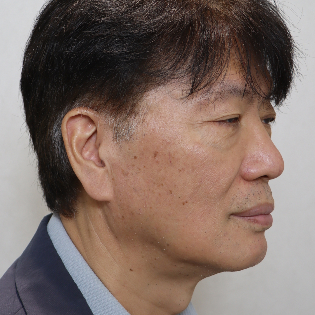 안면거상술 before측면 이미지