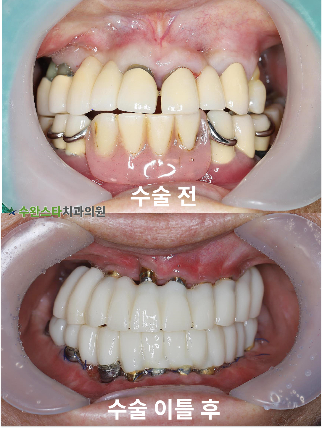 수술 전 / 수술 후 2일 구강 내부 60대 여성 (2024. 12촬영)