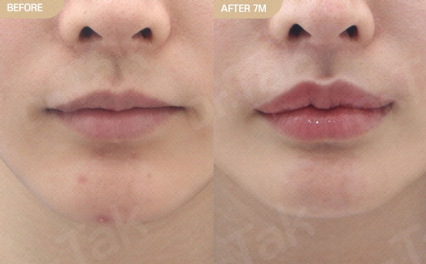 Pillow Lips in Korea: Real Cost vs Results (Complete Guide) : Dr. Tak ...