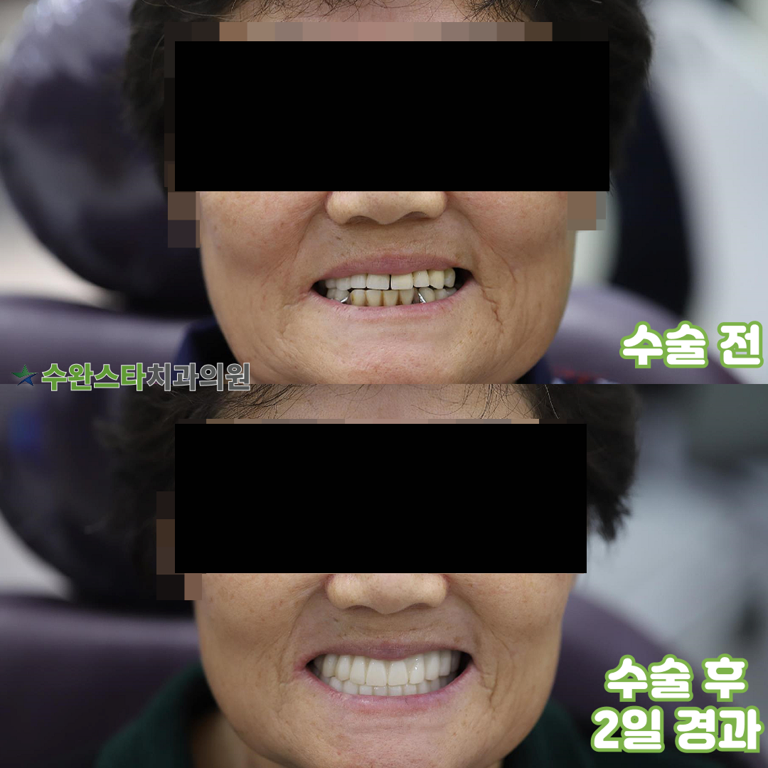 수술 전 / 수술 후 2일 경과, 60대 여성 (2024. 12촬영)