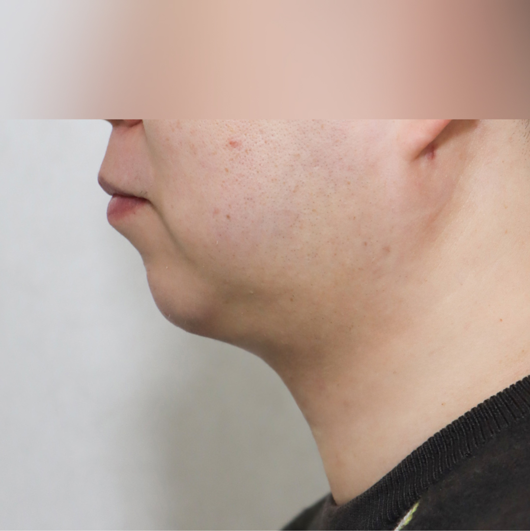 이중턱 after 90도 이미지