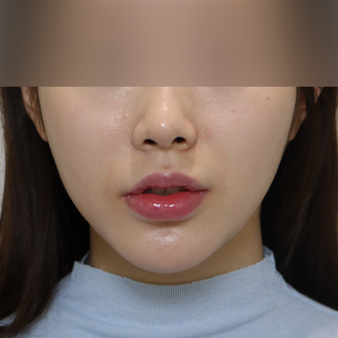 이중턱지방흡입 after정면 이미지