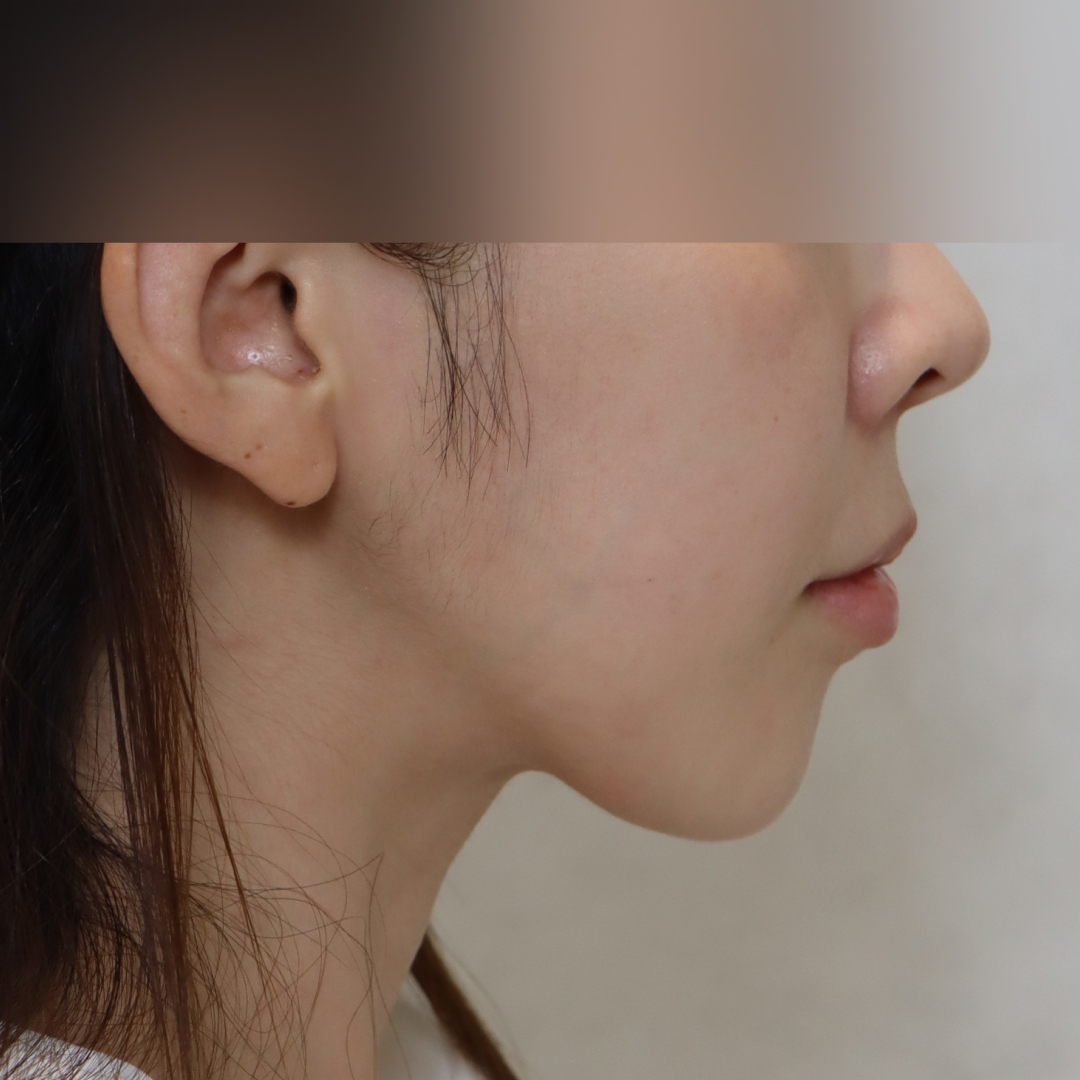 실리프팅 before 90도 이미지