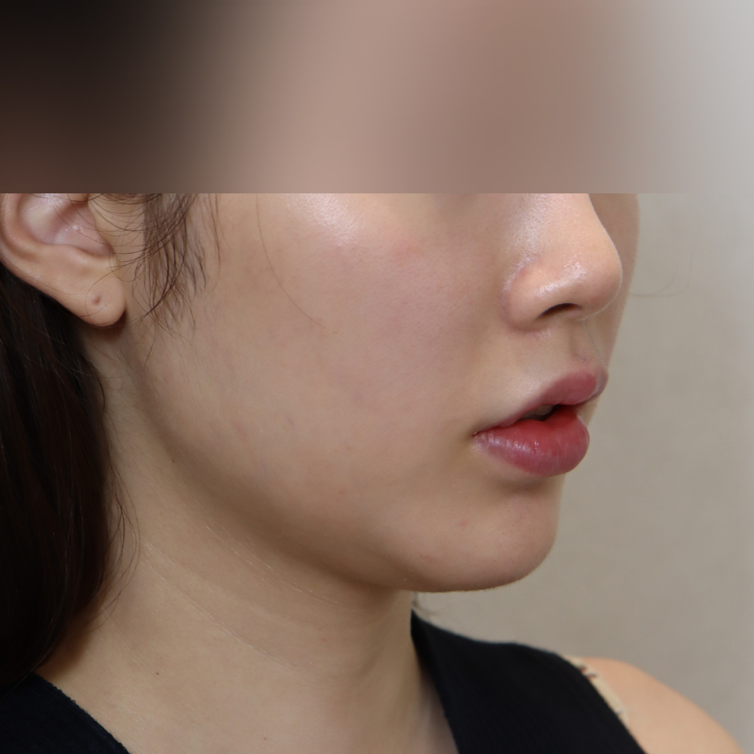 이중턱지방흡입 before측면 이미지