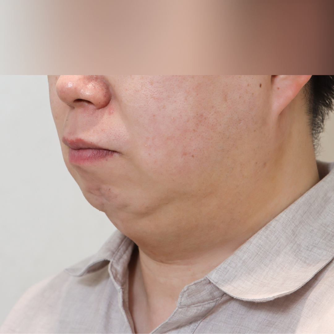 이중턱 before측면 이미지