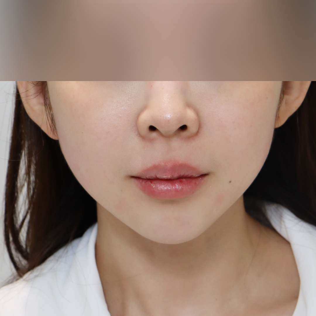 실리프팅 before정면 이미지